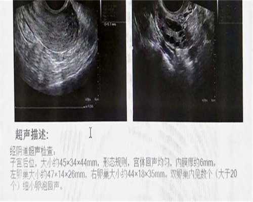 东莞三代试管真实记录—拉拉群体不孕不育检查医院成功经验分享